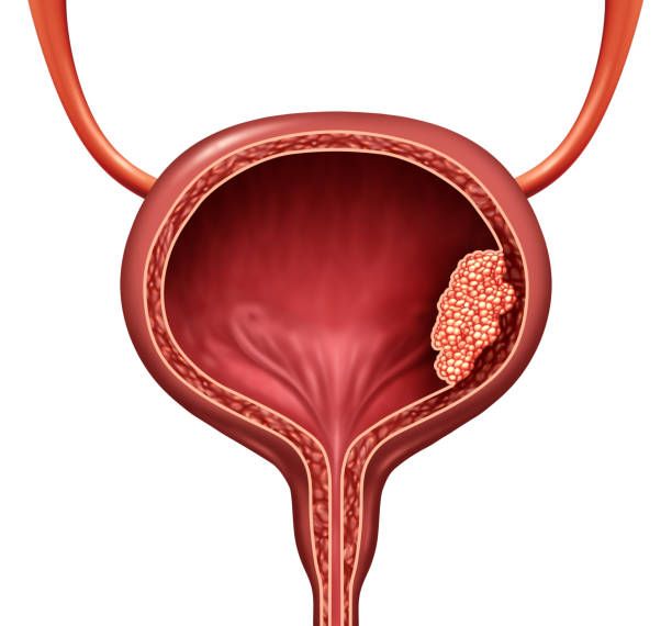 Fizjoterapia Urologiczna W Nowotworze Pęcherza Moczowego Urosilesiapl 5780